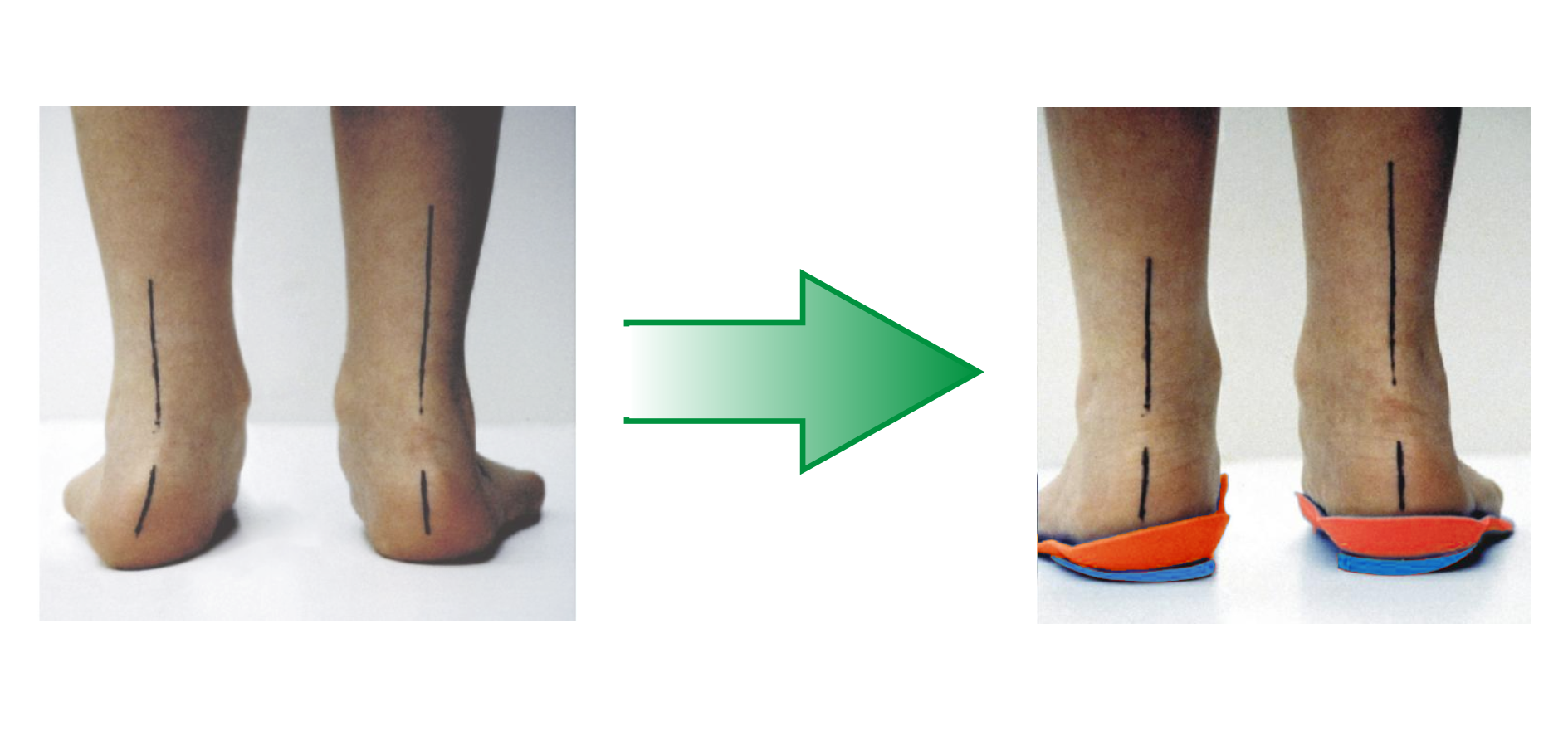 Кривая подошва. Пронация при плоскостопии. Гиперпронация стопы стельки. Стельки ФОРМТОТИКС. Стельки плоско вальгусная стопа.