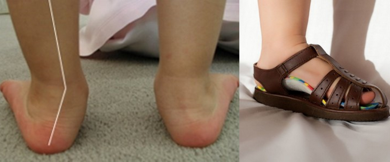 Ортопедическая обувь для детей вальгусная стопа. Плоскостопие вальгусная стопа. Вальгус вальгус плоскостопие. Ортопедическая стелька вальгус. Вальгус плоскостопие стельки.