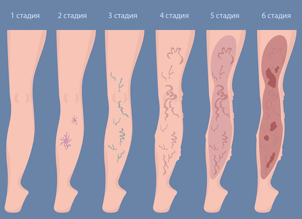 Венозная 6 и 1. Варикоз расширение вен нижних конечностей. Варикозное расширение вен нижних конечностей 1-2 степени. Варикозное расширение вен начальная стадия. Варикозное расширение вен (ВРВ) нижних конечностей.